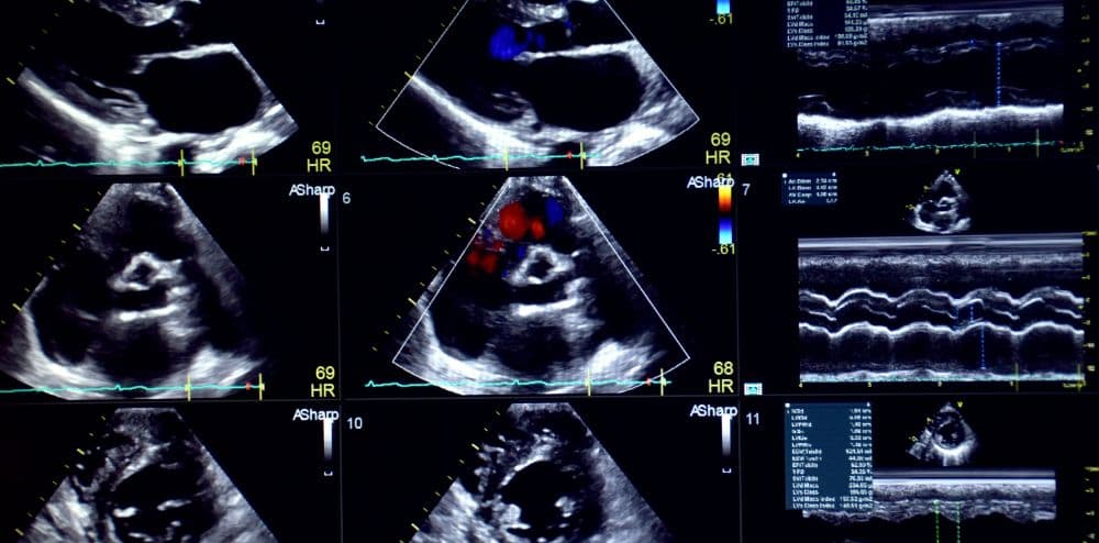 Un patient qui entre dans un scanner Newton